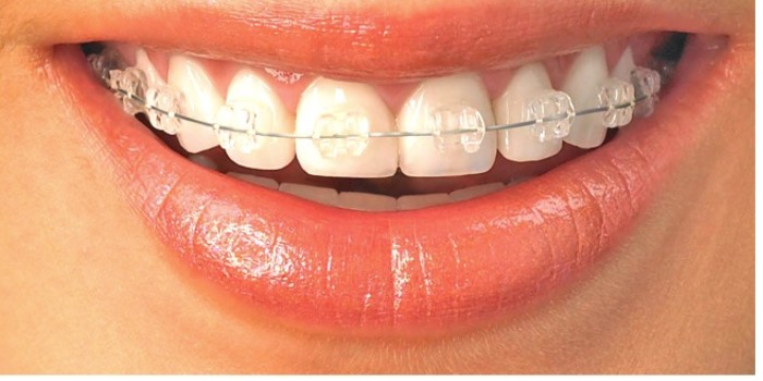gapped teeth with braces